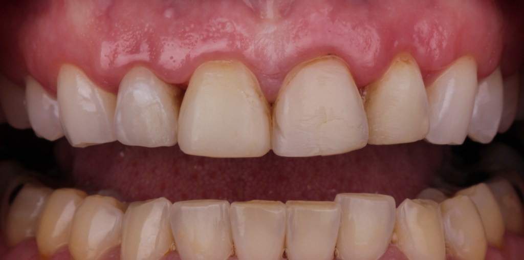 Up-close image of teeth before dental procedure