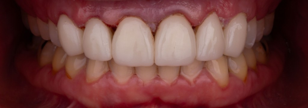 Up-close image of teeth after dental procedure