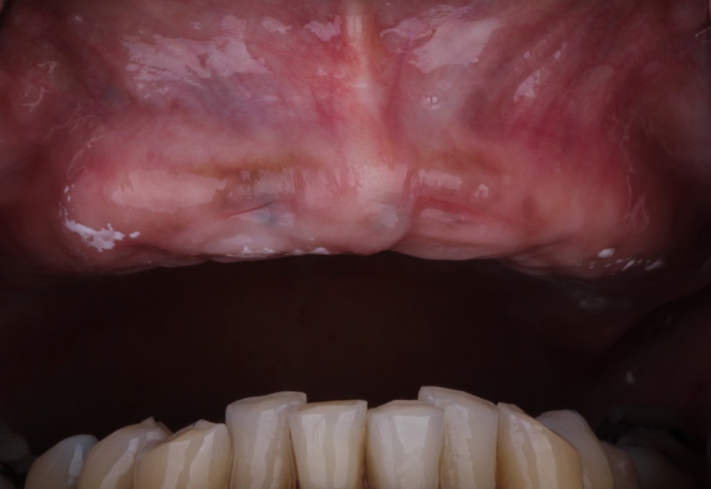Up-close image of teeth before dental procedure