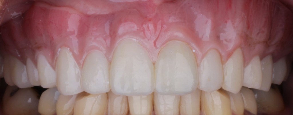 Up-close image of teeth after dental procedure