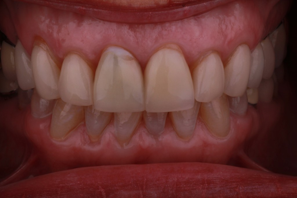 Up-close image of teeth before dental procedure