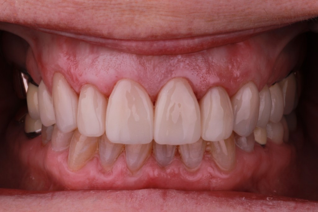 Up-close image of teeth after dental procedure