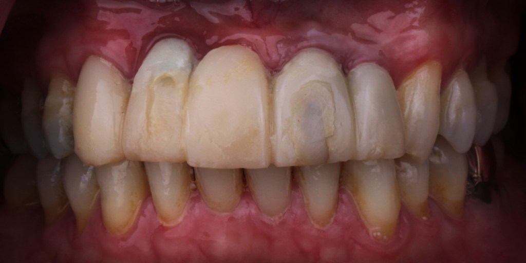 Up-close image of teeth before dental procedure